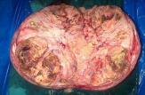 خروج تومور 10 کیلویی از بدن زن 53 ساله